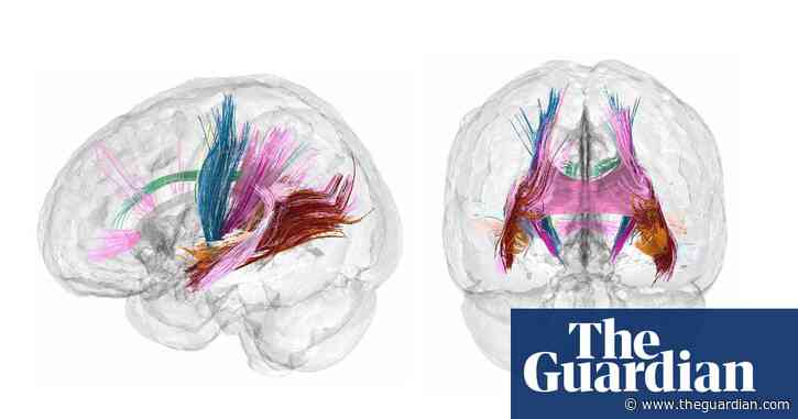 Scans capture sweeping reorganisation of brain in pregnancy