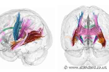 Scans show changes in brain during pregnancy