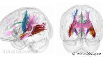 Pregnancy brain changes revealed in detailed scans