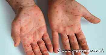 Welsh Government issues update about mpox