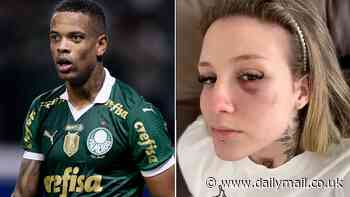 Soccer player's former girlfriend reveals shocking injuries as she presses assault charges