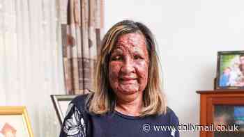 Woman, 59, undergoes astonishing procedure to destroy hundreds of tumours that cover her face