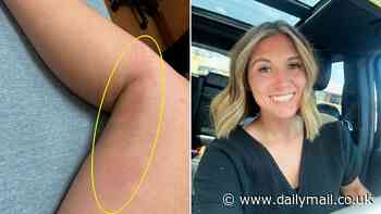 Mom reveals how subtle red mark was actually sign she was suffering a silent health emergency