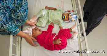 Rare conjoined twin girls separated by British surgeon in major operation