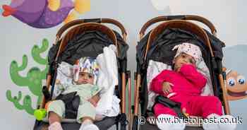 Rare conjoined twin girls separated by British surgeon in major operation