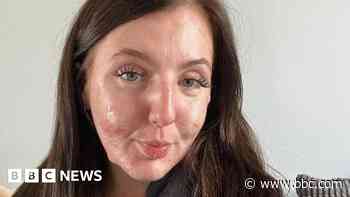 Acne fighter films her skin journey to help others