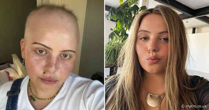 Woman goes completely bald after catching Covid eight times