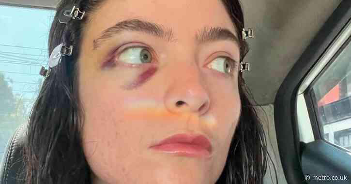 Lorde sparks concern with black eye in cryptic social media return