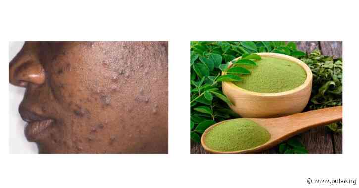 Did you know moringa leaves can clear acne and pimples? Here’s how