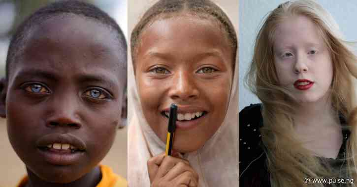 5 types of albinos and what they look like