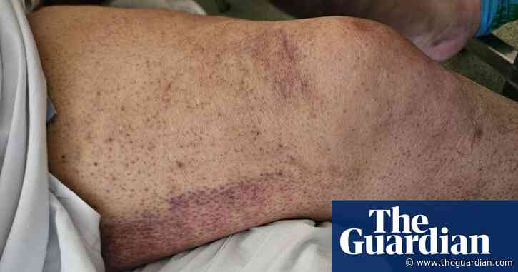 Perth man treated for scurvy as cost-of-living crisis brings back ‘disease of the past’