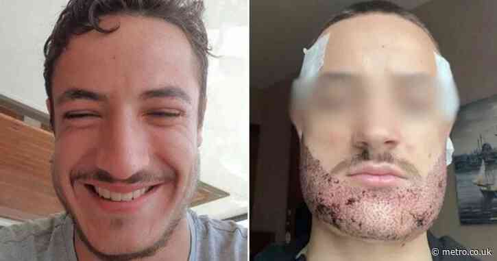 Student takes own life after botched beard transplant by ‘Turkish estate agent’