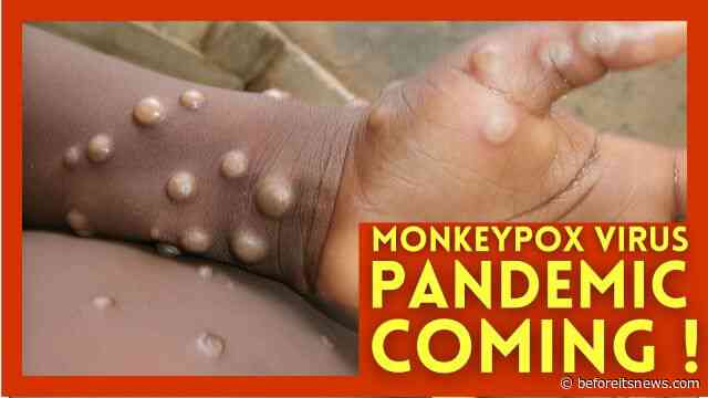 Monkeypox Virus | 5 Things You Should Know About MonkeyPox Outbreak