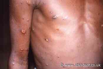 Fourth UK case of more transmissible mpox strain detected