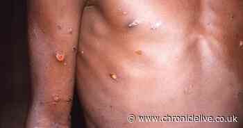 UK Health Security Agency reports fourth UK case of more contagious mpox strain