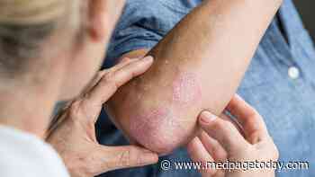 Watch for Psoriasis After Cancer Immunotherapy, Study Says