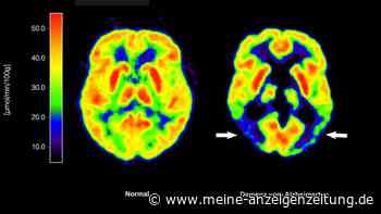 Antikörper Lecanemab: Wie er wirkt und wem er helfen kann