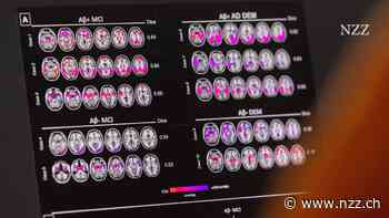 KOMMENTAR - In der EU ist bald ein neues Medikament gegen Alzheimer erhältlich. Das könnte eine neue Ära der Therapie einläuten