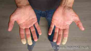 Got cold hands? Take the 1-minute test that reveals if you have debilitating Raynaud's disease