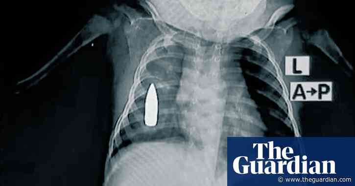 X-rays show shrapnel and bullets buried in children caught in Sudan war