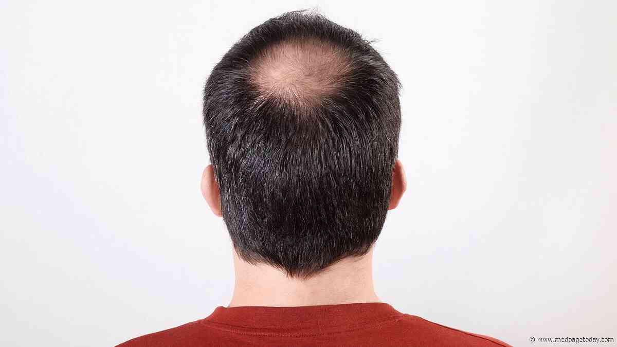 Experts Release Recs on Off-Label Use of Oral Minoxidil for Hair Loss