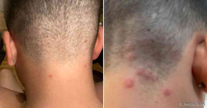 Urgent warning after shocking number of ringworm infections from popular men’s haircut