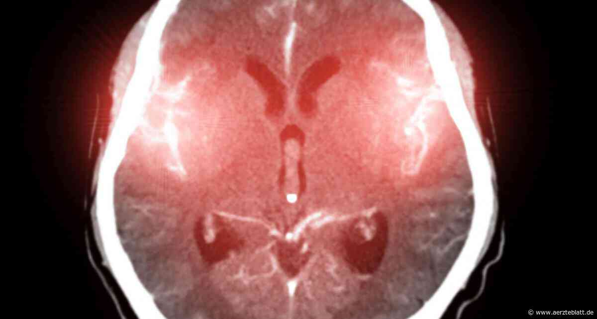 Hirnaneurysma: Bluttransfusionen können Behandlungsergebnisse von Subarachnoidalblutungen verbessern