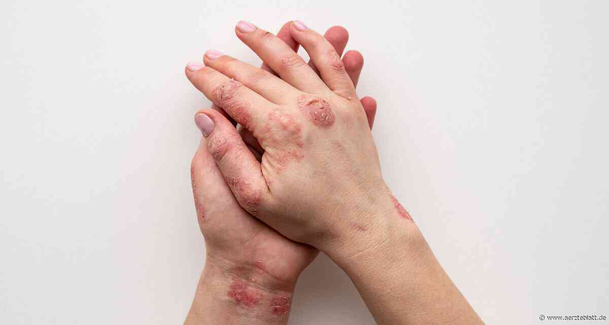 Konsum von hochverarbeiteten Lebensmitteln mit Psoriasis assoziiert