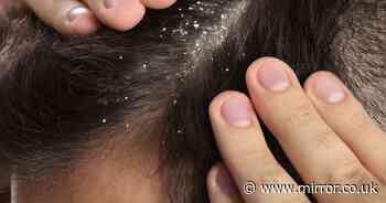 NHS warns dandruff sufferers to buy shampoo with specific ingredient to fix it