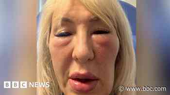 'I paid fake doctor thousands for fillers - now I look like a gargoyle'