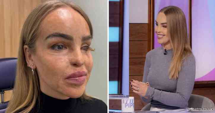 Katie Piper fitted for prosthetic eye after blindness caused by 2008 acid attack