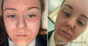 Home Bargains popular product 'left schoolgirl, 13, with painful blisters on her face'