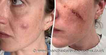 'I thought it was a spot - but it turned out to be a cyst and now I have permanent scars on my face'