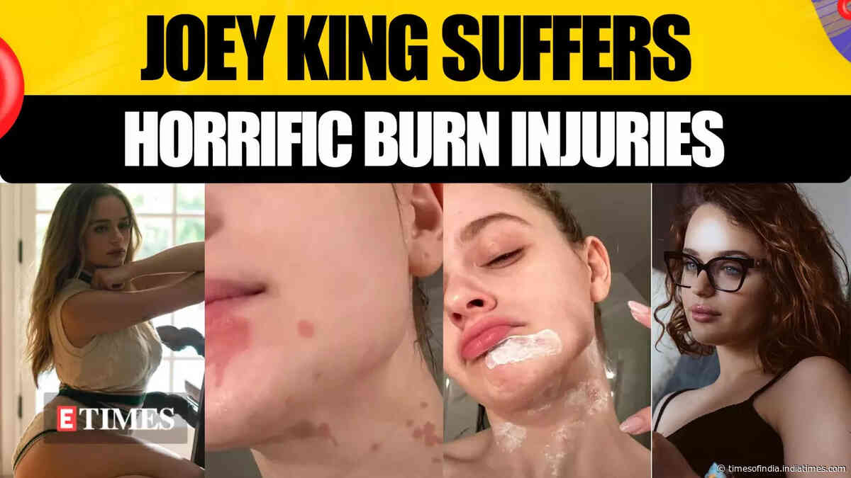 Joey King's Kitchen Nightmare: Suffers Burns On Face & Neck