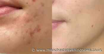 Beauty buffs swear doctor-approved blemish solution is a 'miracle' after seeing results