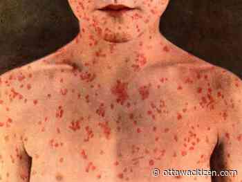 Ontario measles outbreak: Surge of 100 new cases in past week