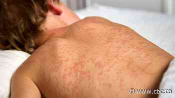 How worried should Sask. people be about measles?
