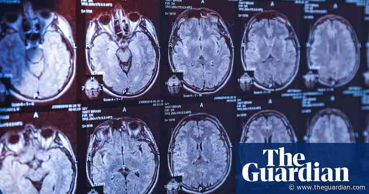 Blood test could detect Parkinson’s disease before symptoms emerge