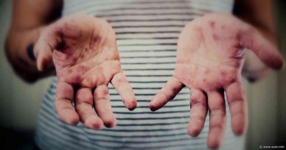 NC hospitals in state of standby, preparing as measles threat grows