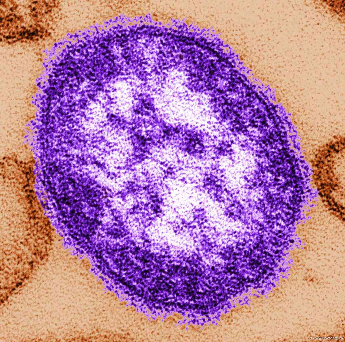 Manitoba warns of new measles exposure sites south of Winnipeg