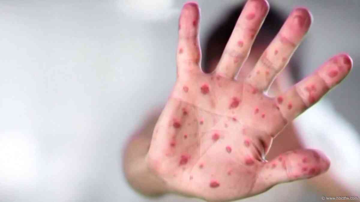 First Tarrant County measles cases confirmed