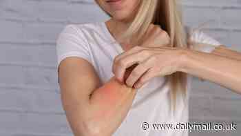 One in four women say menopause triggered eczema symptoms