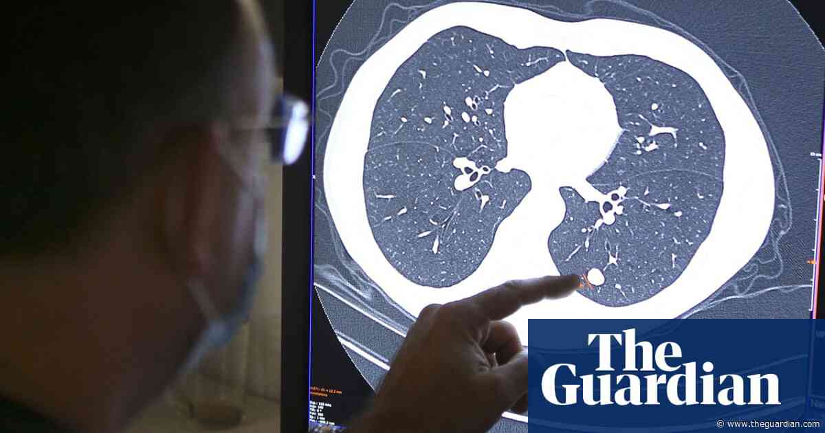 NHS in England urged to become ‘early intervention service’ on cancer