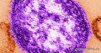 Measles exposure alert issued for communities south of Winnipeg
