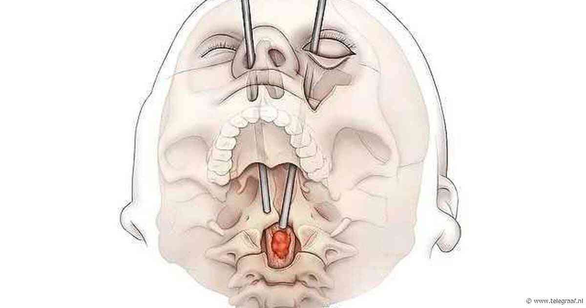 Medische primeur: chirurgen verwijderen tumor in wervelkolom van patiënt via oogkas