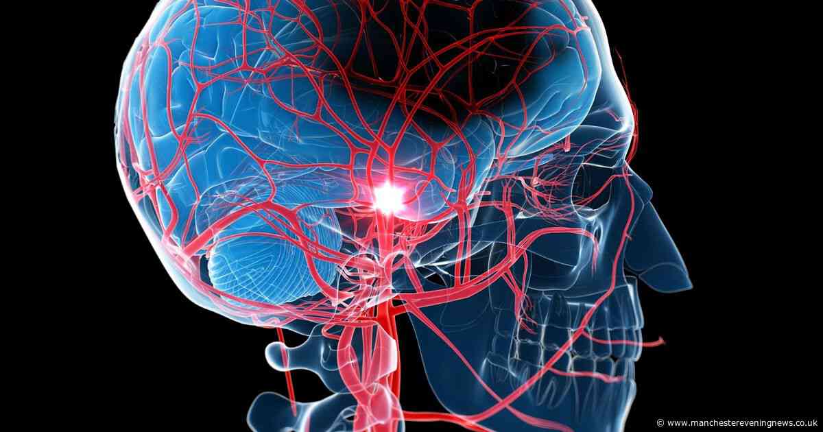 Stroke victims found to have '50 times more microplastics' in their arteries
