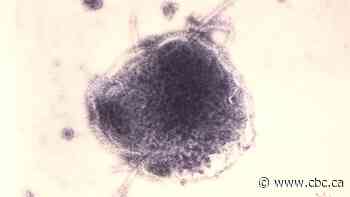 1 case of measles confirmed in Nova Scotia