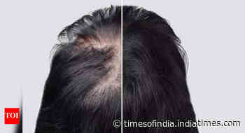 Signs you may be developing a bald spot on your head
