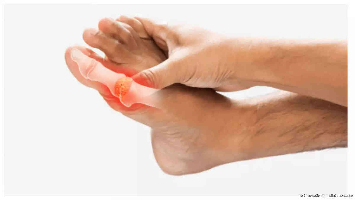 5 symptoms of high uric acid that often go unnoticed