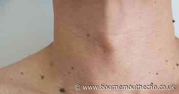 Free mole checks to be offered by dermatologists